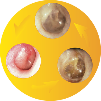 耳蜗Otoscopia e Otites RA